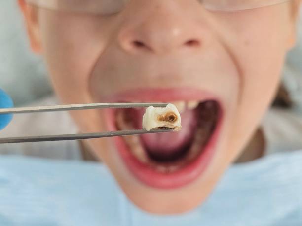 Best Emergency Gum Treatment in Cambria, IL